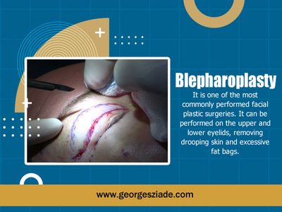 Blepharoplasty Lebanon