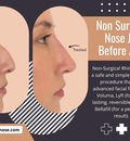 NonSurgical Nose Job Before After